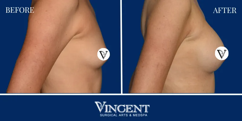 Breast 1-3