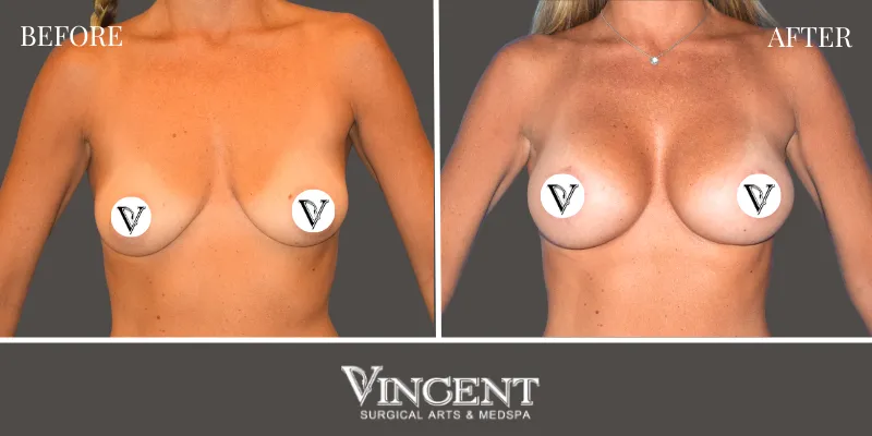 Breast 2-1