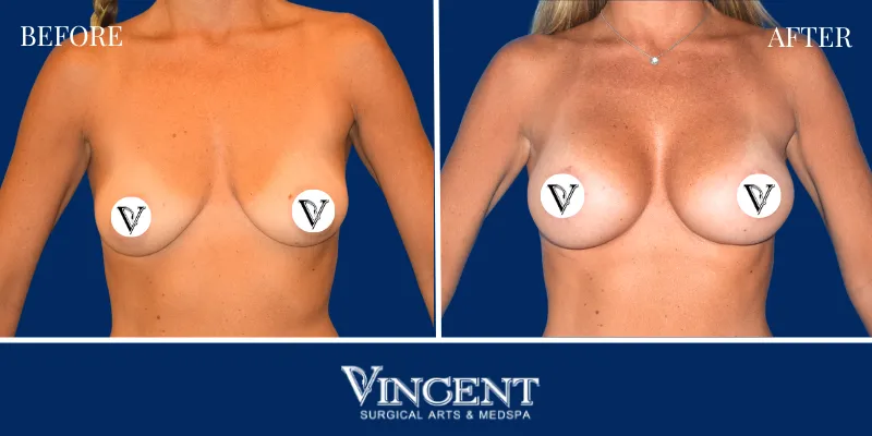 Breast 2-1