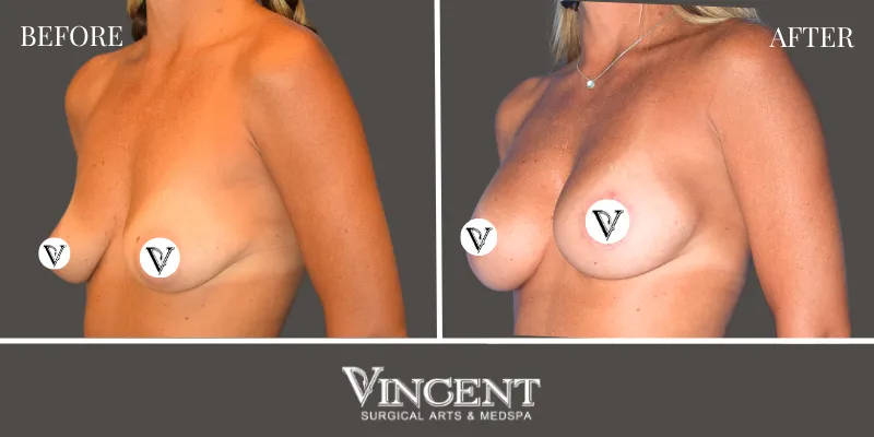 Breast 2-2