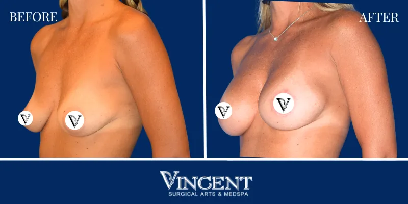 Breast 2-2