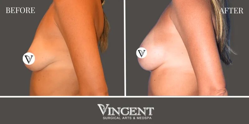 Breast 2-3
