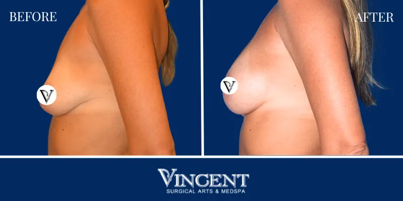 Breast 2-3
