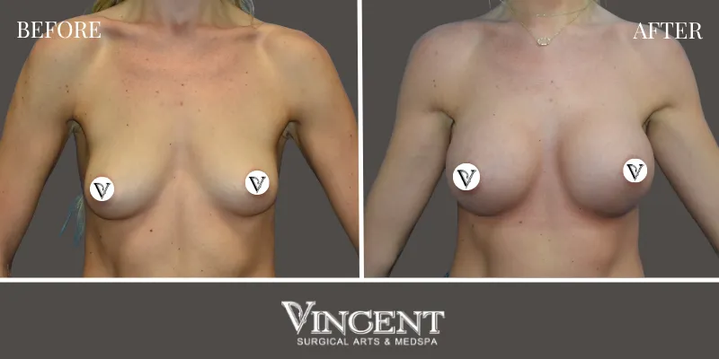 Breast 3-1