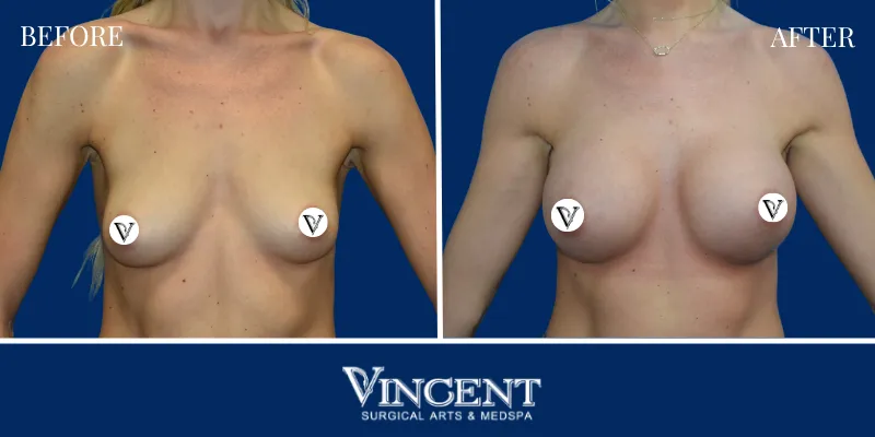 Breast 3-1