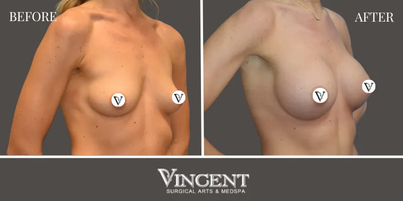 Breast 3-2