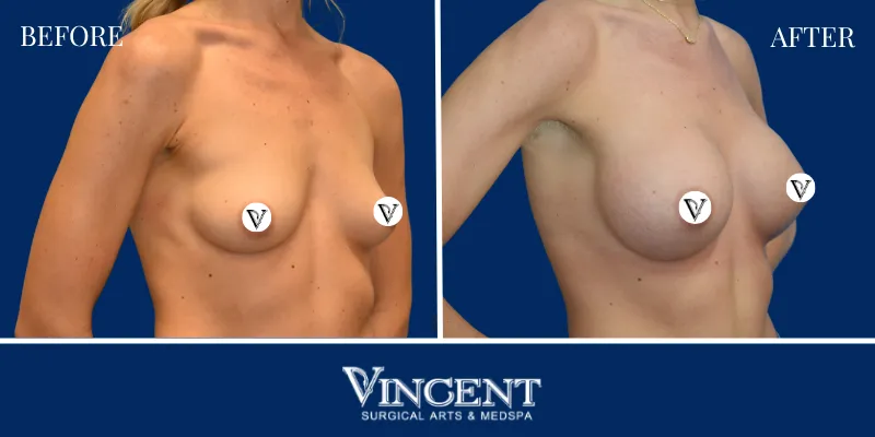 Breast 3-2