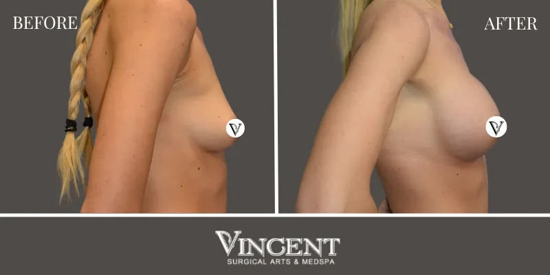 Breast 3-3
