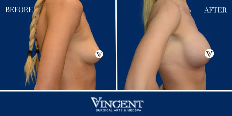 Breast 3-3