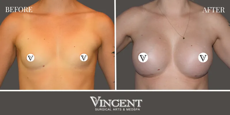 Breast 4-1