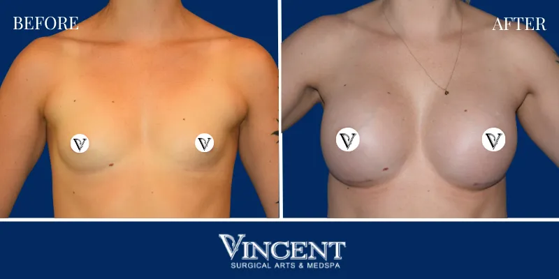 Breast 4-1