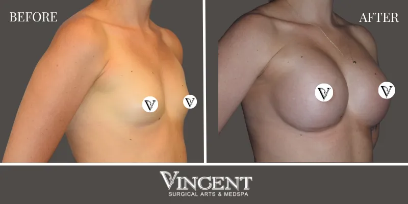 Breast 4-2