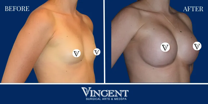 Breast 4-2