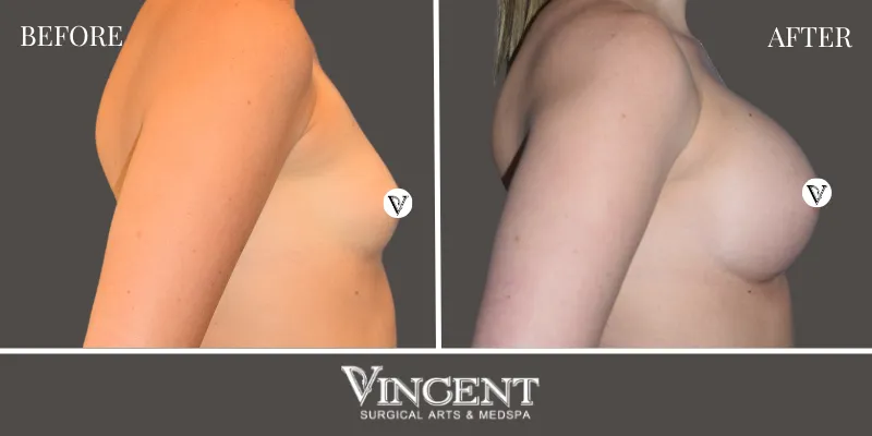 Breast 4-3