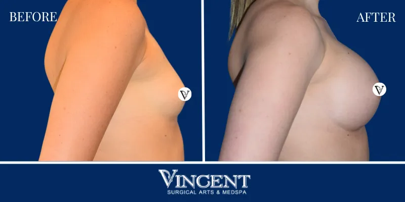 Breast 4-3