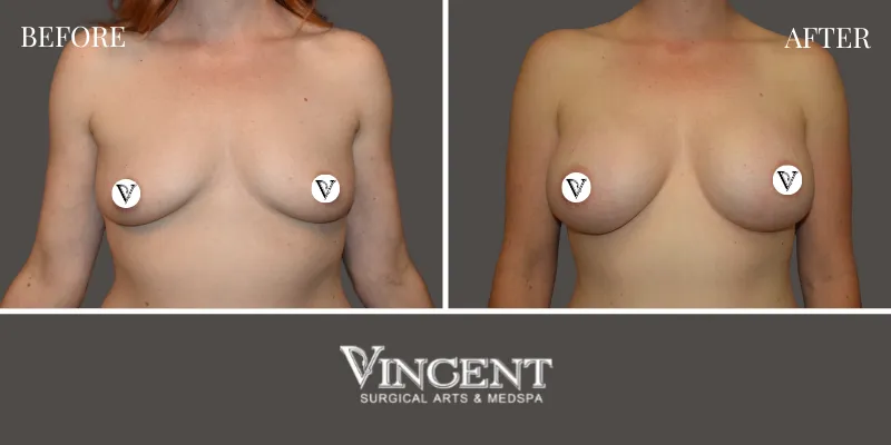 Breast 5-1