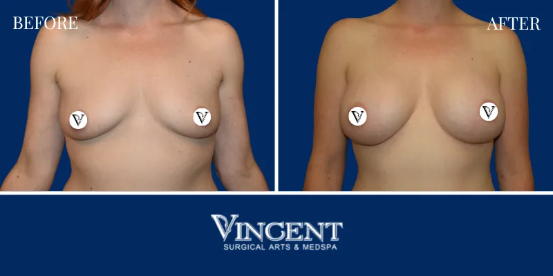 Breast 5-1