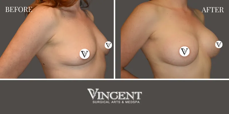 Breast 5-2