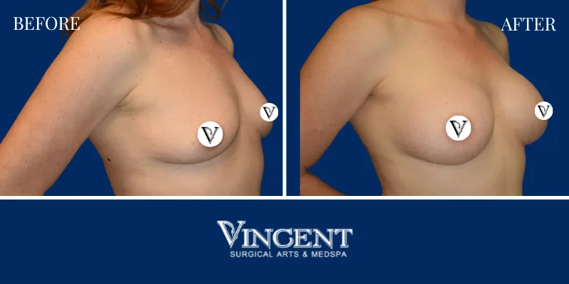 Breast 5-2