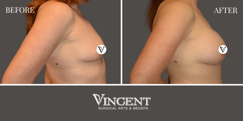Breast 5-3