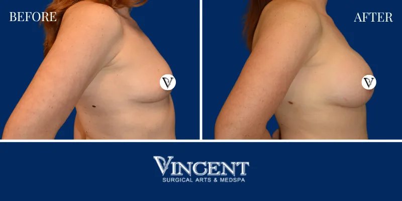 Breast 5-3