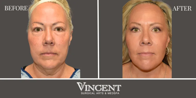 Facelift 2-1