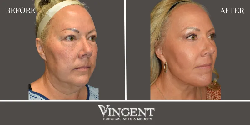 Facelift 2-2