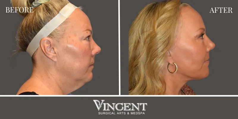 Facelift 2-3