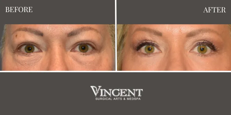 Facelift 2-4
