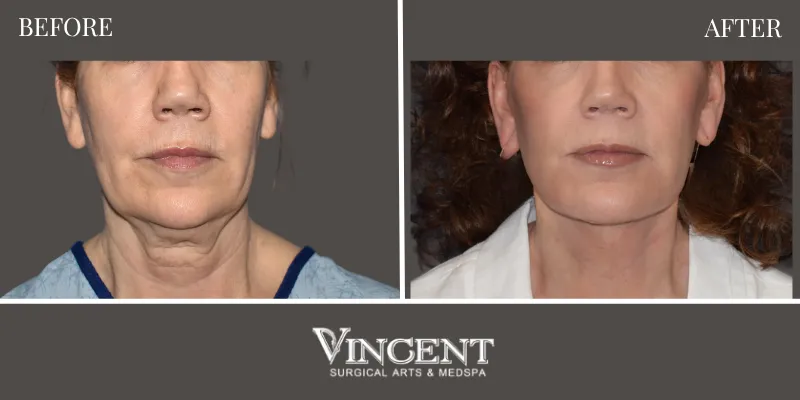 Facelift 4-1