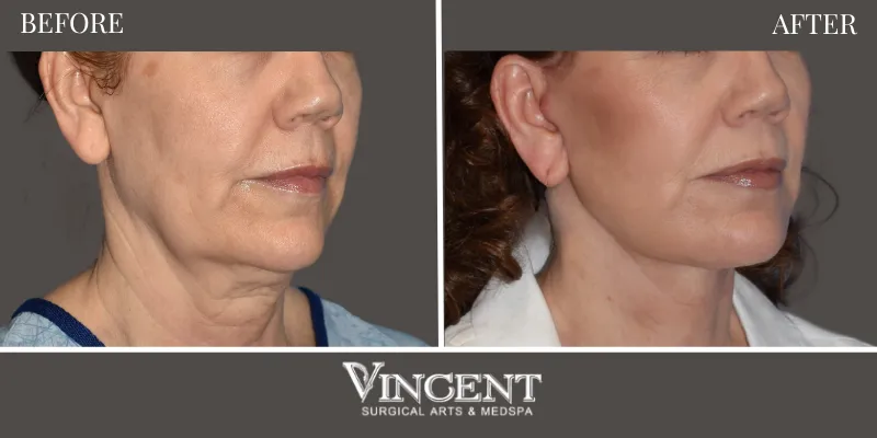 Facelift 4-2
