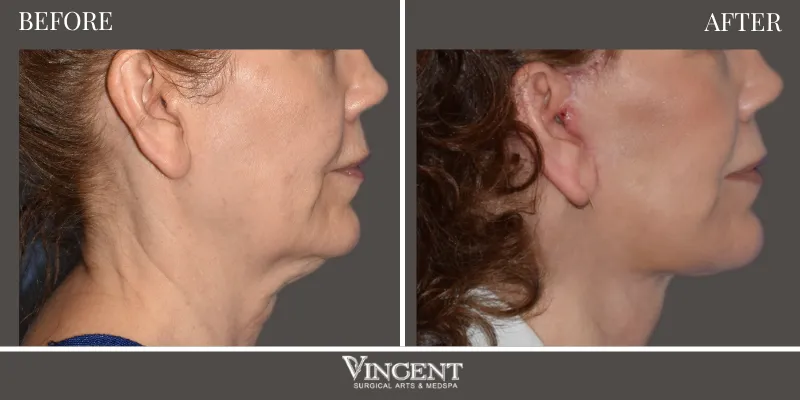 Facelift 4-3