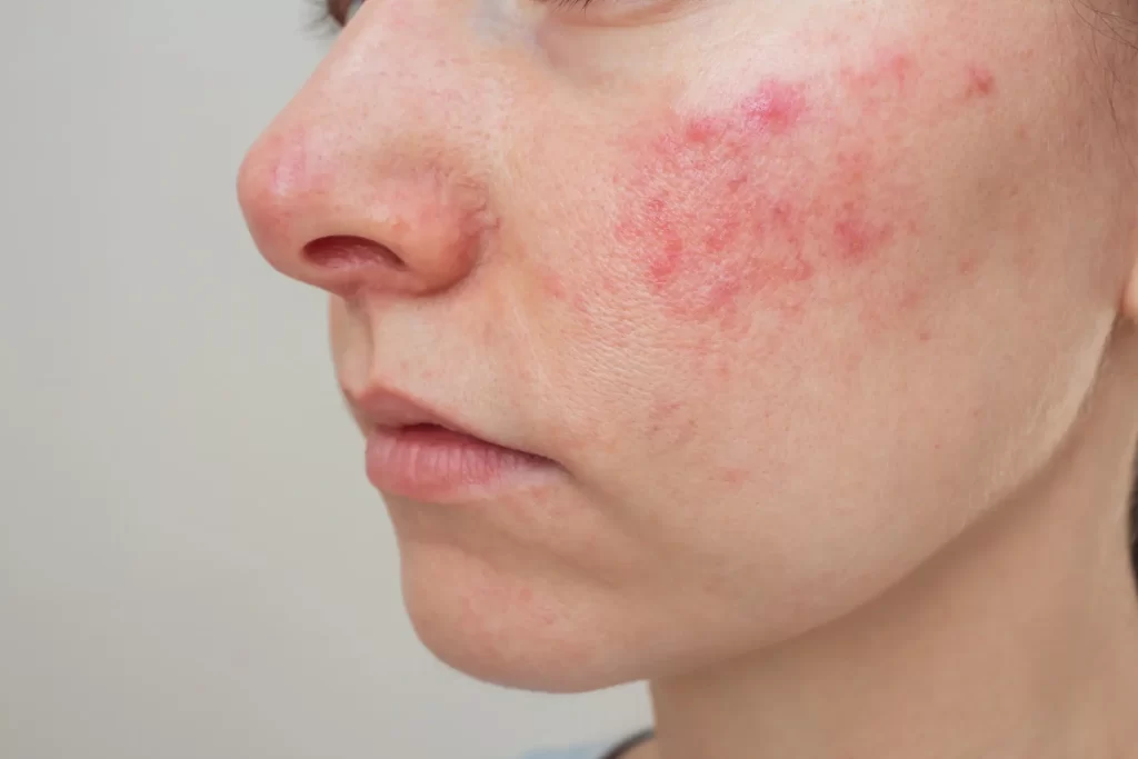 Woman with rosacea