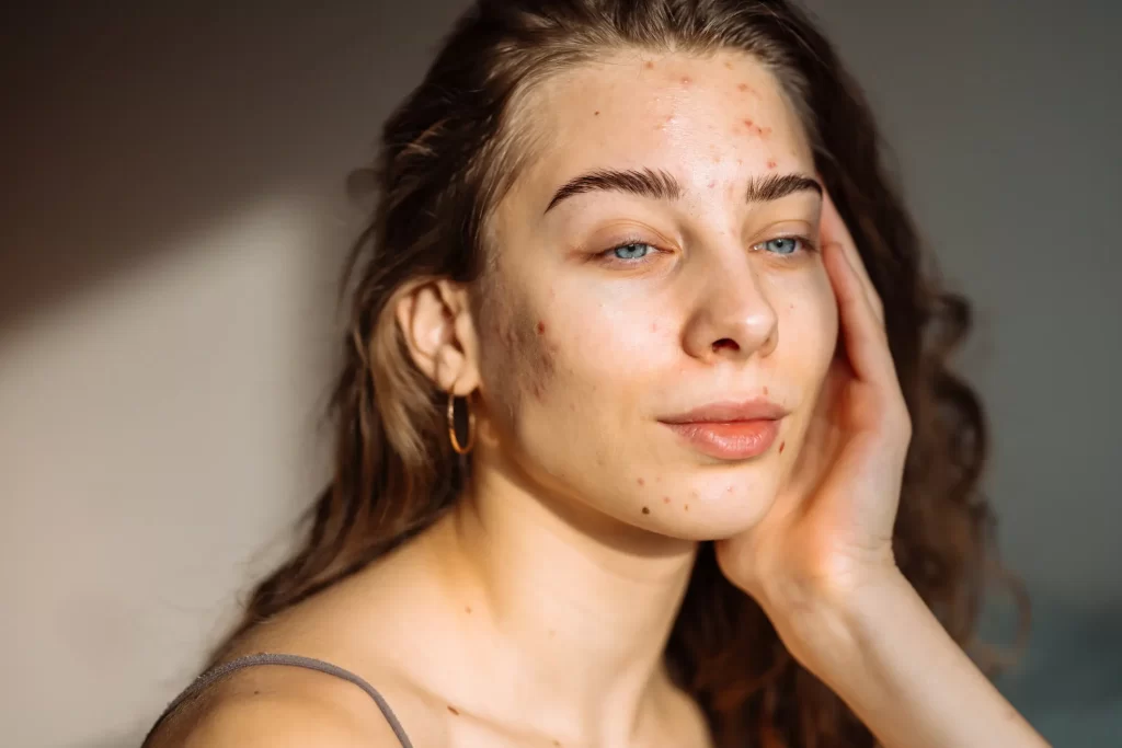 Woman with acne scars
