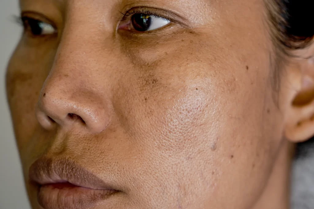Face with hyperpigmentation