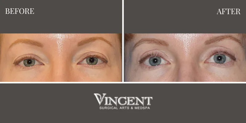 Blepharoplasty 3-1