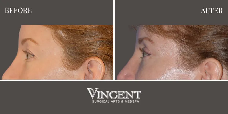 Blepharoplasty 3-2