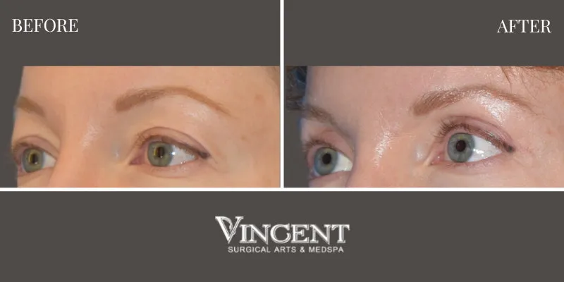 Blepharoplasty 3-3