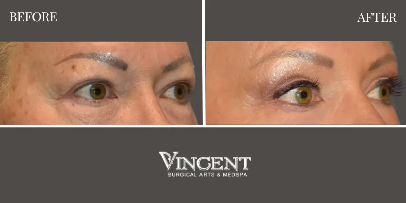 Blepharoplasty 4-1