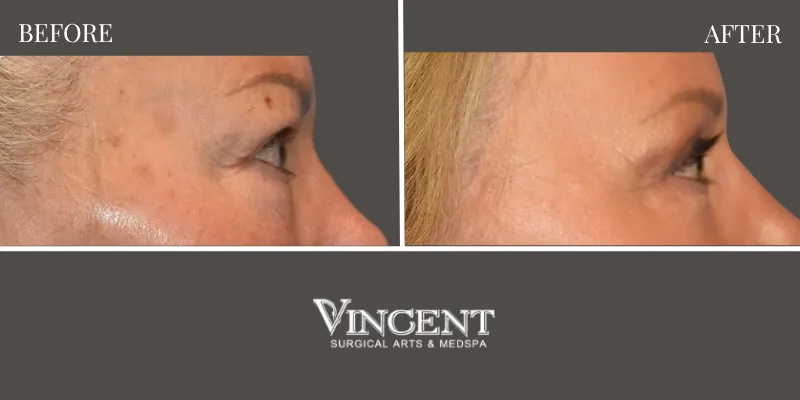 Blepharoplasty 4-2