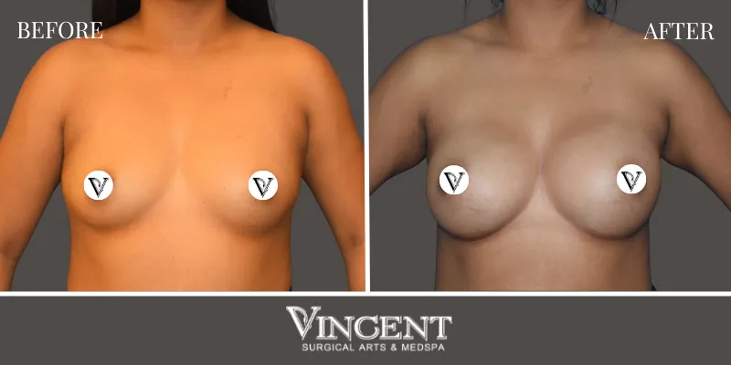 Breast 6-1