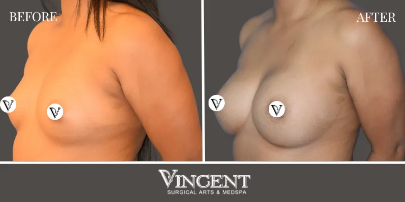Breast 6-2