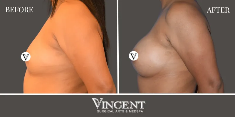 Breast 6-3