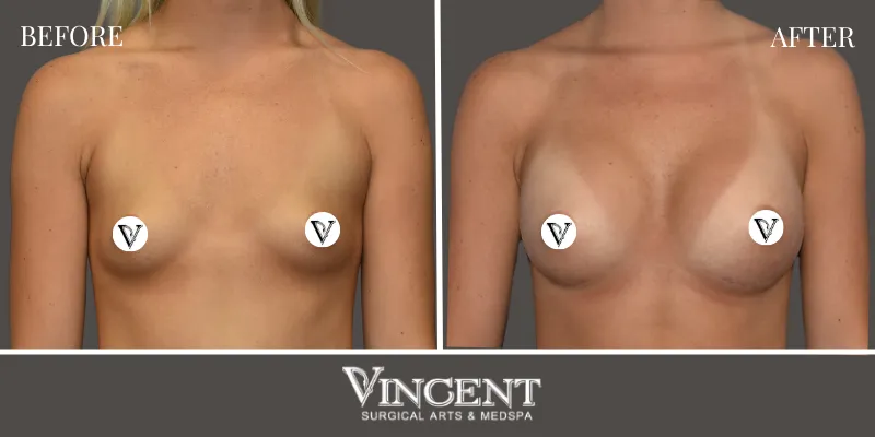 Breast 7-1