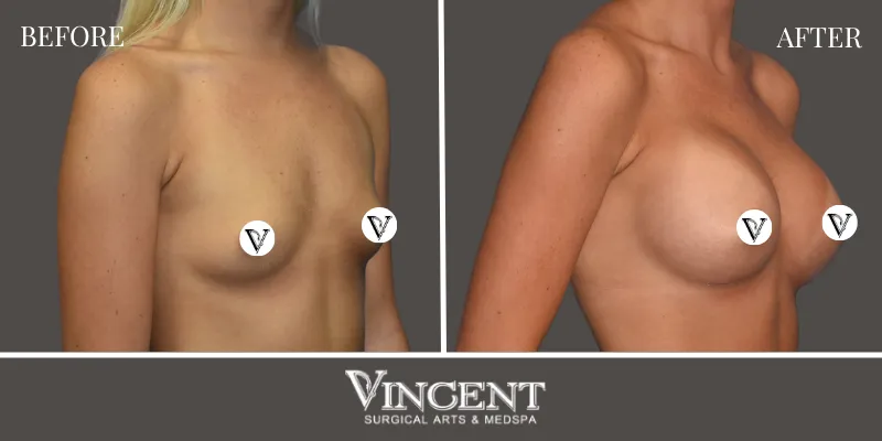 Breast 7-2