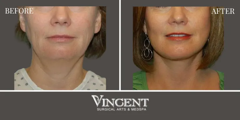 Chin Implant1-1