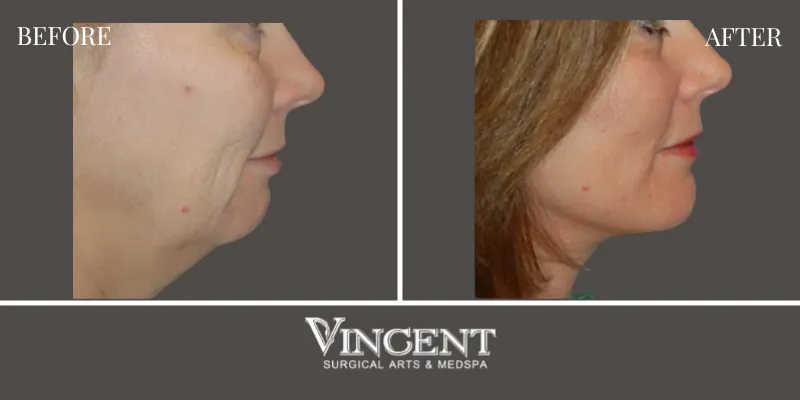 Chin Implant1-2