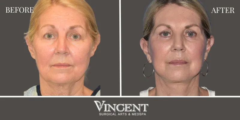Facelift 1-1