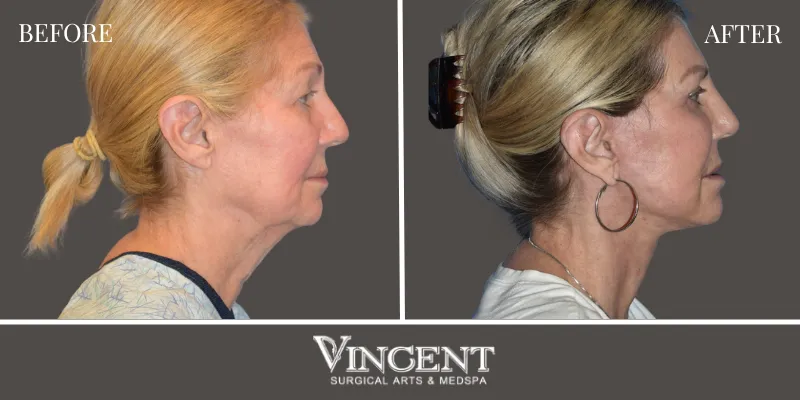Facelift 1-2