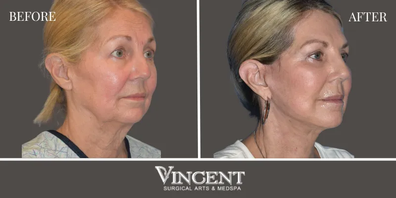 Facelift 1-3